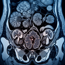 МРТ органів малого тазу